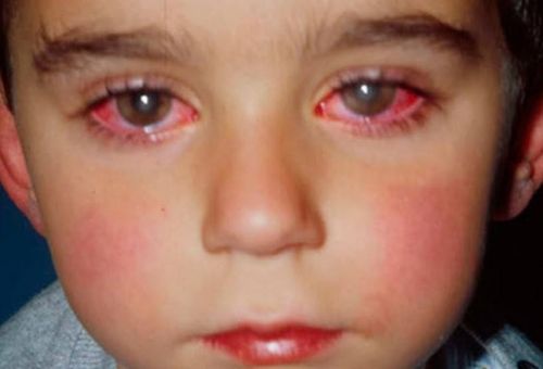 Tuyên truyền bệnh đau mắt  đỏ ở trẻ trong trường Mầm non